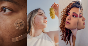 Pro Tips On How To Get Rid of Acne Overnight